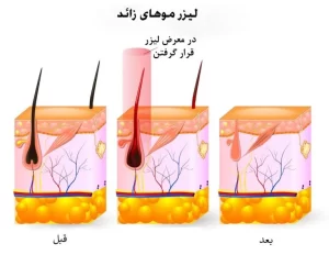 لیزر موهای زائد